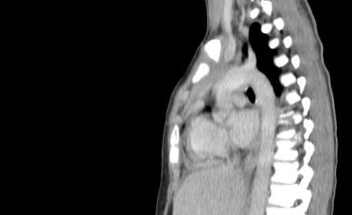 Bronchial mucoepidermoid carcinoma (Radiopaedia 57023-63895 Sagittal 132).jpg