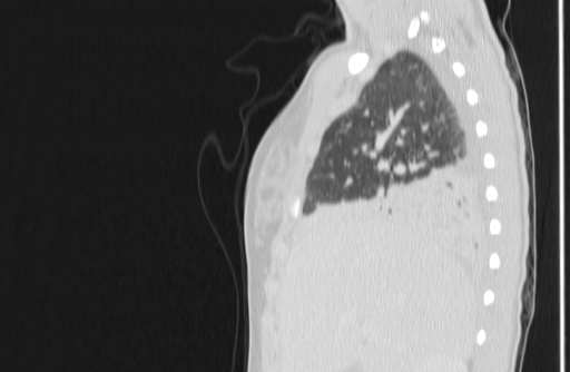 File:Bronchial mucoepidermoid carcinoma (Radiopaedia 57023-63895 Sagittal lung window 20).jpg