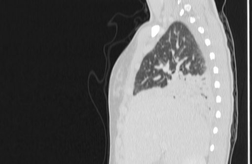 Bronchial mucoepidermoid carcinoma (Radiopaedia 57023-63895 Sagittal lung window 26).jpg
