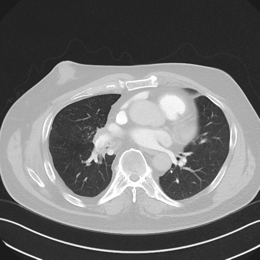 Bronchiectasis (Radiopaedia 39385-41666 Axial lung window 35).png