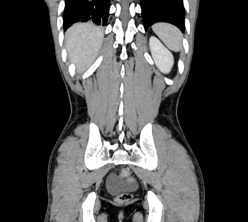 Bronchiectasis in Crohn disease (Radiopaedia 60311-67977 C 72).jpg