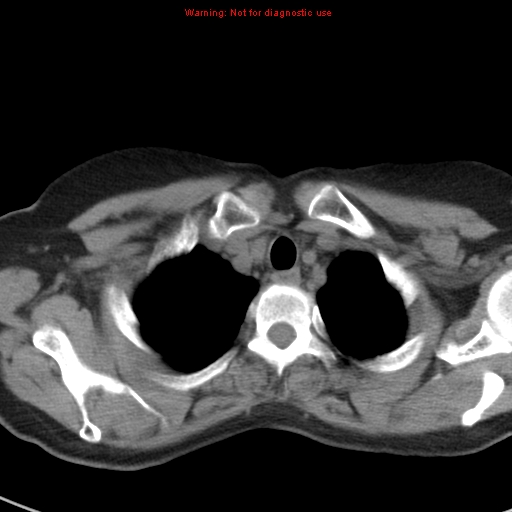 File:Bronchoalveolar carcinoma (BAC) (Radiopaedia 13436-13392 Axial non-contrast 6).jpg