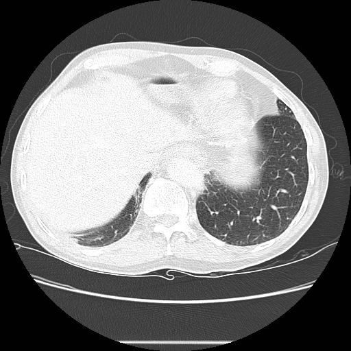 Bronchocele (Radiopaedia 17097-16795 Axial lung window 100).jpg