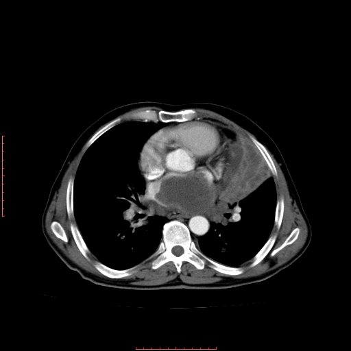 File:Bronchogenic carcinoma with left atrial large deposit - T4N3M1a (Radiopaedia 42316-45428 A 17).jpg