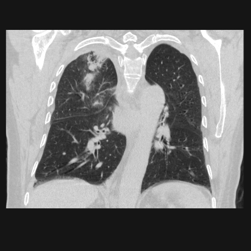 File:Bronchogenic carcinoma with metastatic lymphadenopathy (Radiopaedia 37671-39569 Coronal lung window 31).jpg