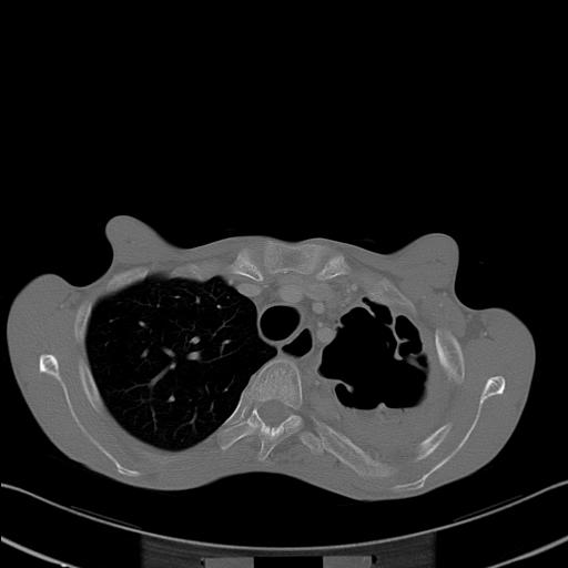 File:Bronchopleural fistula secondary to tuberculosis (Radiopaedia 20415-20322 Axial bone window 8).jpg