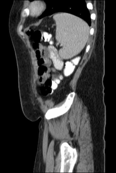 Brown tumors compressing the spinal cord (Radiopaedia 68442-77988 F 47).jpg