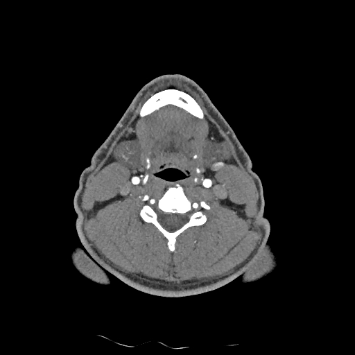 Buccal fat pad arteriovenous malformation (Radiopaedia 70936-81144 D 136).jpg