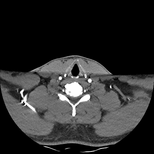 Buccal fat pad arteriovenous malformation (Radiopaedia 70936-81144 D 91).jpg