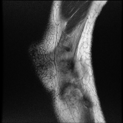 File:Bucket-handle meniscus tear (Radiopaedia 65700-74809 Sagittal T2 23).jpg
