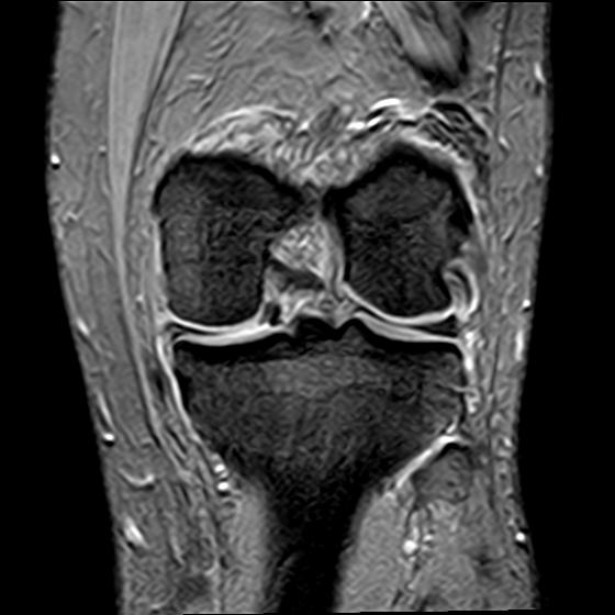 File:Bucket handle tear - medial meniscus (Radiopaedia 29250-29664 B 13).jpg