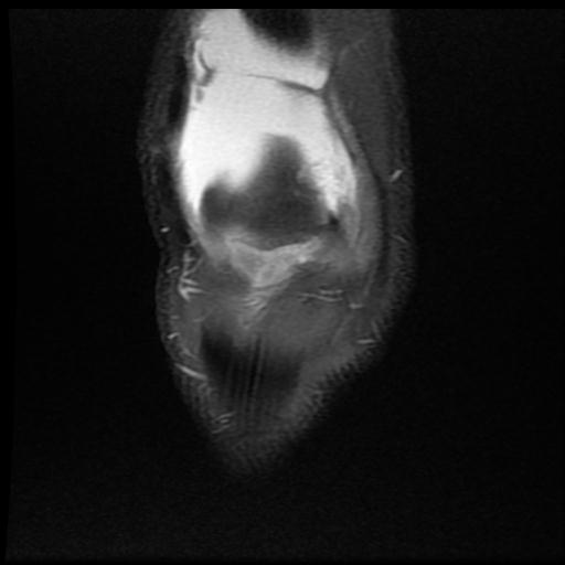 File:Bucket handle tear - medial meniscus (Radiopaedia 69245-79026 Coronal PD fat sat 3).jpg