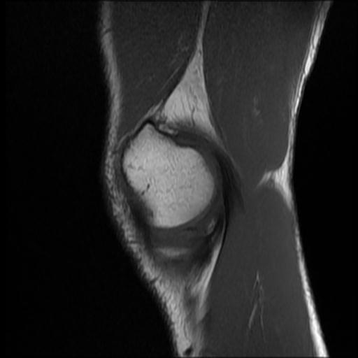 File:Bucket handle tear - medial meniscus (Radiopaedia 69245-79026 Sagittal T1 16).jpg