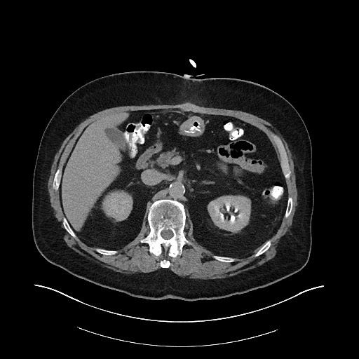 File:Buried bumper syndrome - gastrostomy tube (Radiopaedia 63843-72575 Axial Inject 4).jpg