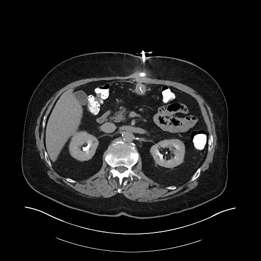 File:Buried bumper syndrome - gastrostomy tube (Radiopaedia 63843-72575 Axial Inject 7).jpg