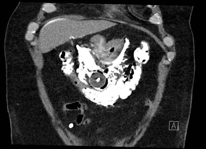 File:Buried bumper syndrome - gastrostomy tube (Radiopaedia 63843-72577 Coronal Inject 31).jpg