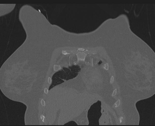 Burst fracture - thoracic spine (Radiopaedia 30238-30865 Coronal bone window 30).jpg