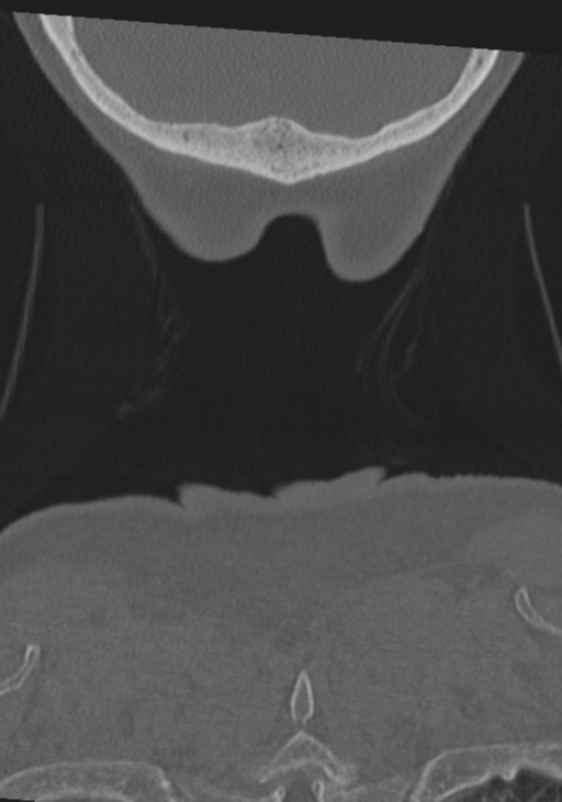 C2 fracture with vertebral artery dissection (Radiopaedia 37378-39199 Coronal bone window 65).png