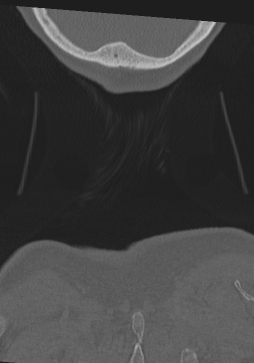 C2 fracture with vertebral artery dissection (Radiopaedia 37378-39199 Coronal bone window 71).png