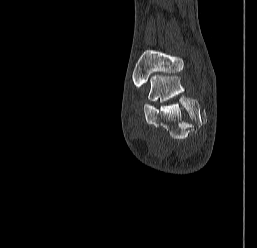 Calcaneal fracture - Sanders type 4 (Radiopaedia 90179-107370 Coronal bone window 72).jpg