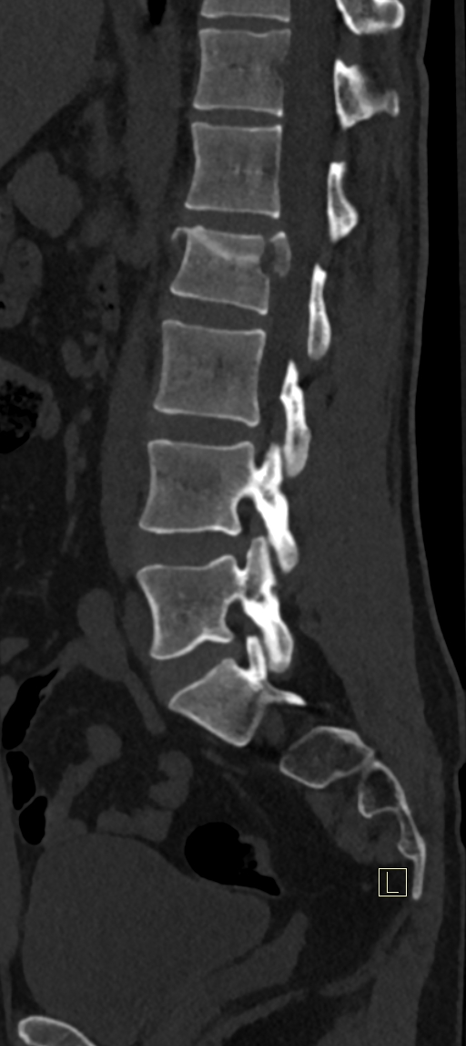 Calcaneal fractures with associated L2 burst fracture (Radiopaedia 71671-82493 Sagittal bone window 31).jpg