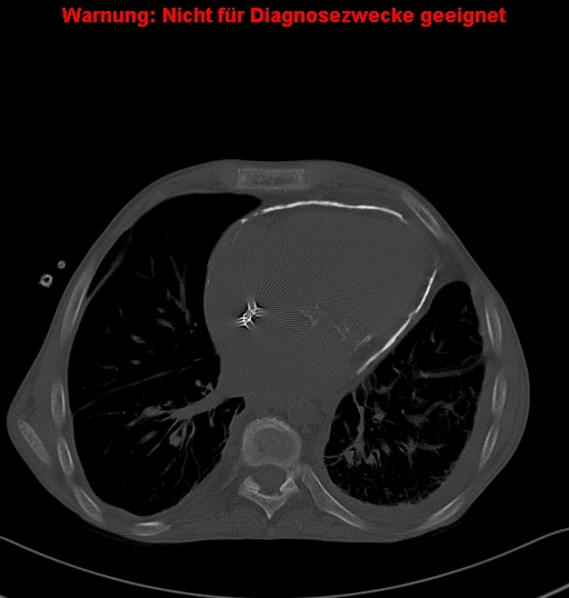 File:Calcific constrictive pericarditis (Radiopaedia 24701-24967 Axial bone window 19).jpg