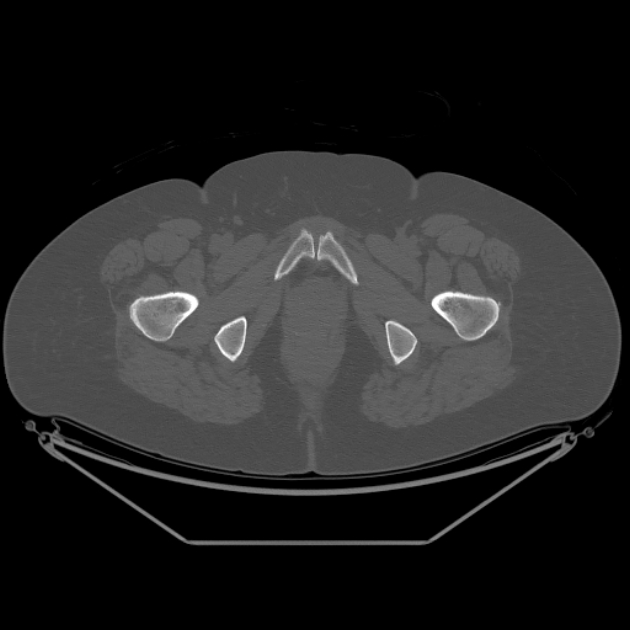Calcific tendinitis of the gluteus medius muscle (Radiopaedia 66998-76318 Axial bone window 65).jpg