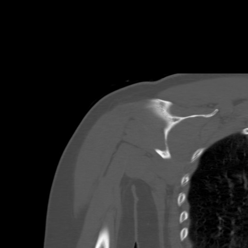 File:Calcific tendinitis of the infraspinatus tendon (Radiopaedia 87256-103539 Coronal bone window 38).jpg