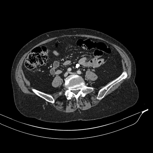 Calcified adrenal glands and Spigelian hernia (Radiopaedia 49741-54988 A 143).jpg