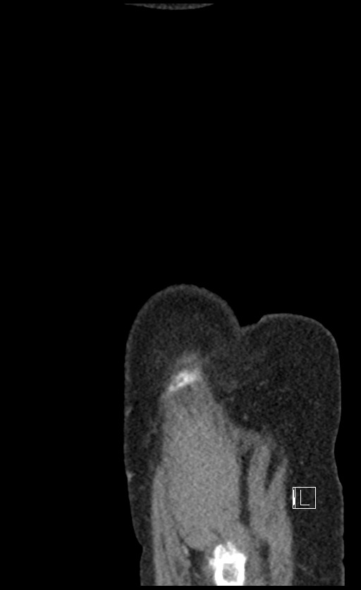 Calcified adrenal glands and Spigelian hernia (Radiopaedia 49741-54988 C 2).jpg