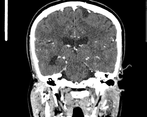 Calcified cerebral hydatid cyst (Radiopaedia 65603-74717 C 42).jpg