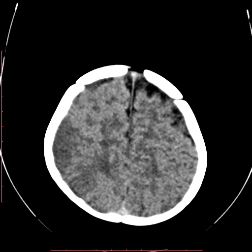 File:Calcified middle cerebral artery embolism (Radiopaedia 78949-91860 Axial non-contrast 21).jpg