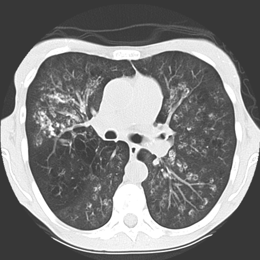 File:Calciphylaxis and metastatic pulmonary calcification (Radiopaedia 10887-11317 Axial lung window 18).jpg