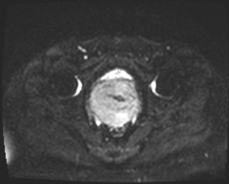 Cancer cervix - stage IIb (Radiopaedia 75411-86615 Axial DWI 12).jpg