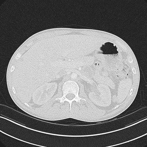 Cannonball metastases - testicular choriocarcinoma (Radiopaedia 84510-99891 Axial lung window 101).jpg