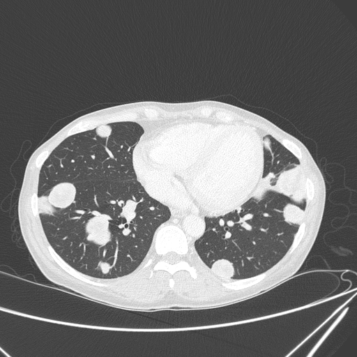 File:Canonball lung metastasis (Radiopaedia 77634-89837 Axial lung window 125).jpg