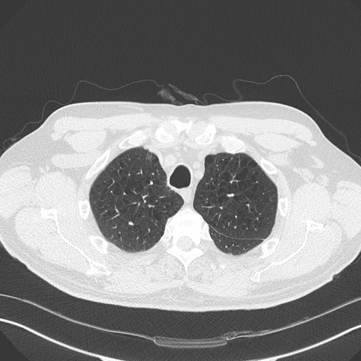 Caplan syndrome (Radiopaedia 56667-63530 Axial lung window 43).jpg