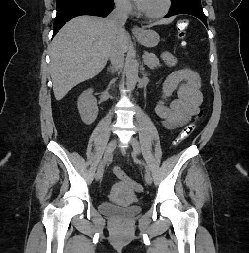 Carcinoid tumor - terminal ileum (Radiopaedia 60931-68740 Coronal non-contrast 57).jpg