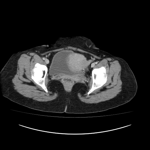 File:Carcinoma colon - hepatic flexure (Radiopaedia 19461-19493 A 120).jpg