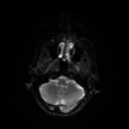 Carcinoma ex-pleomorphic adenoma of parotid (Radiopaedia 28383-28627 Ax DWI B-500 GE 24).jpg