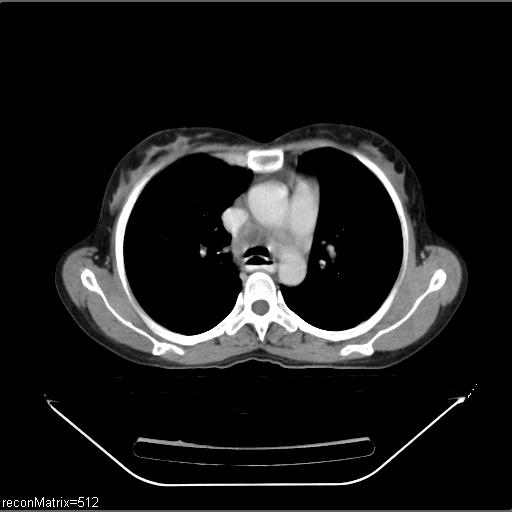 File:Carcinoma of esophagus (Radiopaedia 27356-27550 A 22).jpg