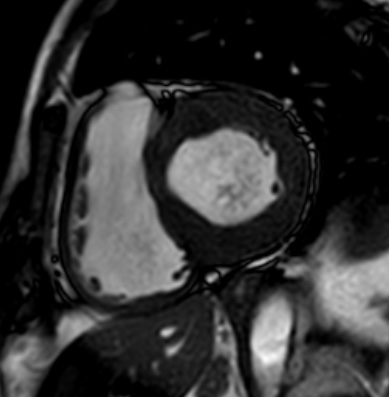 Cardiac amyloidosis - ATTR wild-type (Radiopaedia 74412-85296 short axis cine SSFP 124).jpg