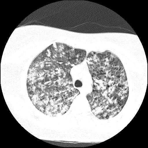 Cardiac angiosarcoma (Radiopaedia 66010-75181 Axial lung window 68).jpg