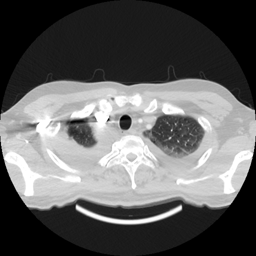 Cardiac tamponade (Radiopaedia 78607-91368 Axial lung window 5).jpg