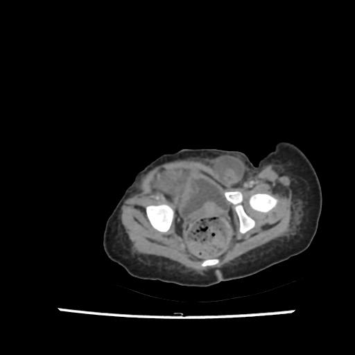 File:Caroli disease with autosomal recessive polycystic kidney disease (ARPKD) (Radiopaedia 89651-106703 B 213).jpg