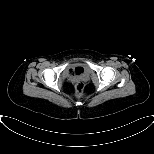 Caroli disease with medullary sponge kidney (Radiopaedia 82622-96804 Axial non-contrast 73).jpg