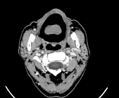 Carotid body tumor (Radiopaedia 61750-69757 Axial Post contrast 18).jpg