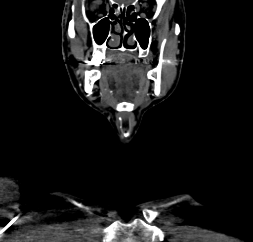 File:Carotid body tumor (Radiopaedia 83615-98727 B 31).jpg