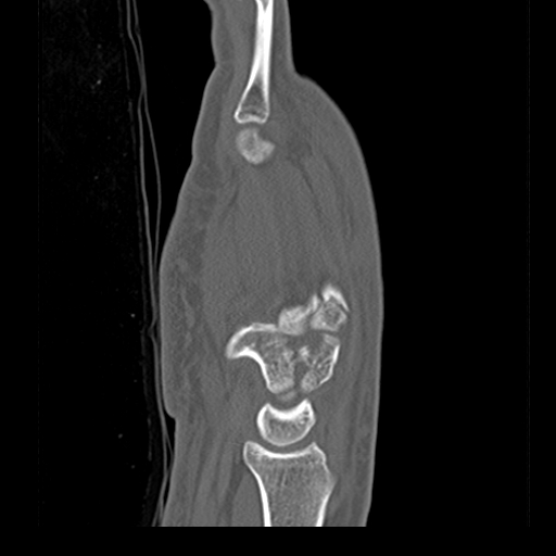 File:Carpo-metacarpal fracture-dislocations with hamatum split fracture (Radiopaedia 18482-18343 Sagittal bone window 10).jpg
