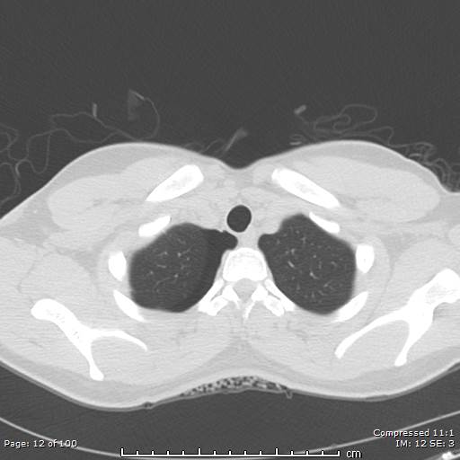 File:Catamenial pneumothorax (Radiopaedia 54382-60600 Axial non-contrast 12).jpg
